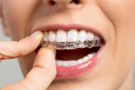 Przezroczyste nakładki prostujące zęby – przełom w leczeniu ortodontycznym